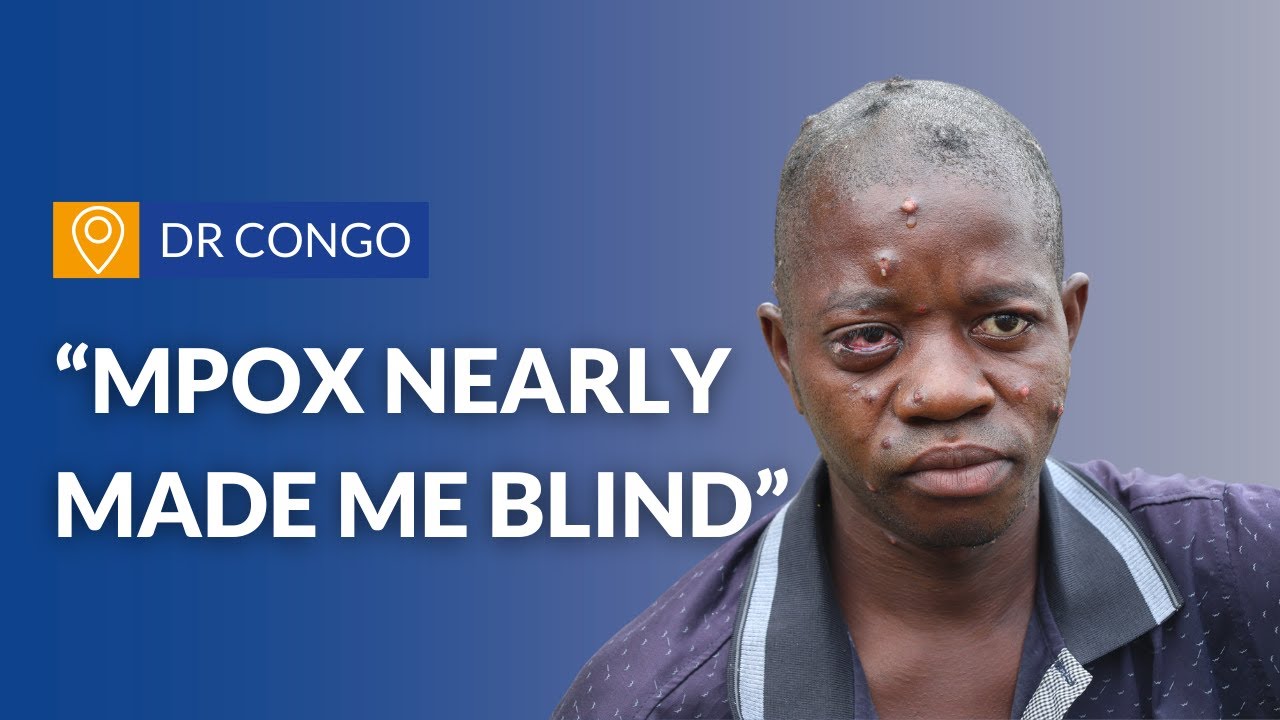 "Mpox nearly made me blind" | DRC | ALIMA