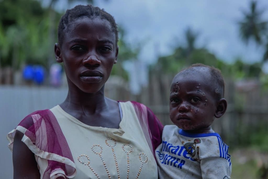 Mpox Epidemic: What is ALIMA Doing? 2 Mpox malades mere bebe 1